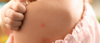 Picaduras de insectos